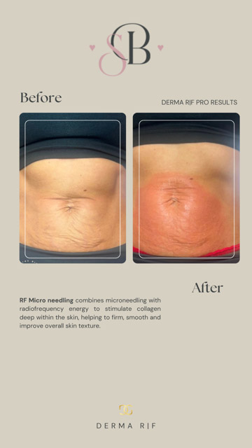 Before-After-1