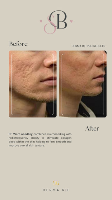 Before-After-10