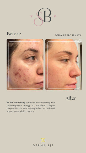Before-After-11