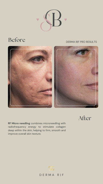 Before-After-12