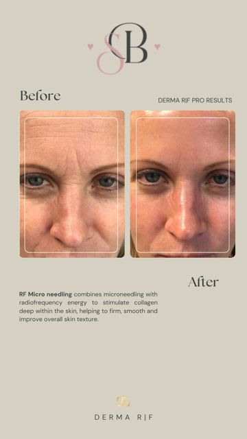 Before-After-13