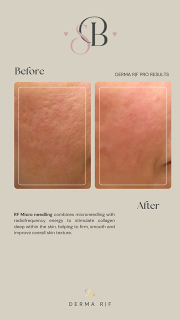 Before-After-14