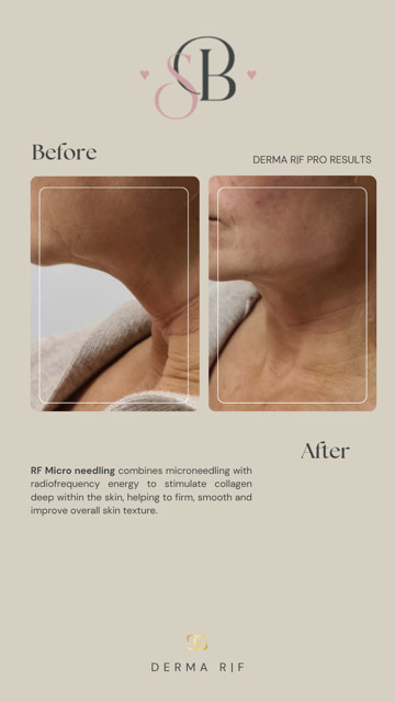 Before-After-15
