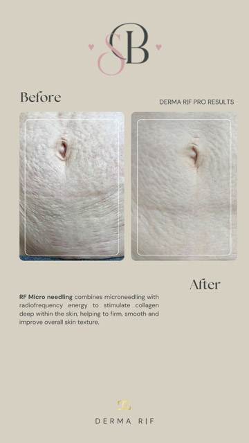 Before-After-2