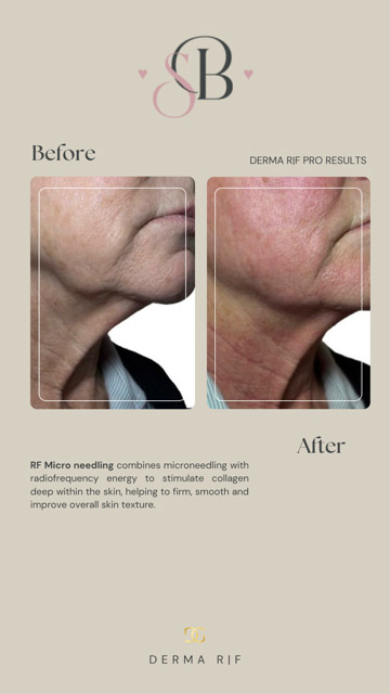 Before-After-3