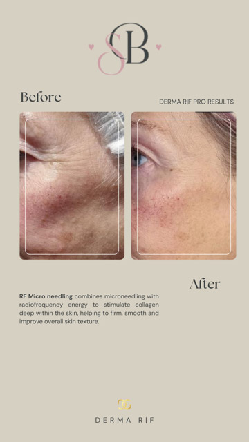Before-After-5