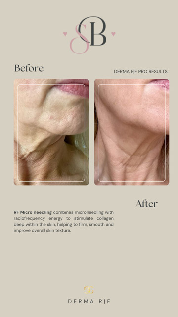 Before-After-6