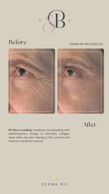 Before-After-9