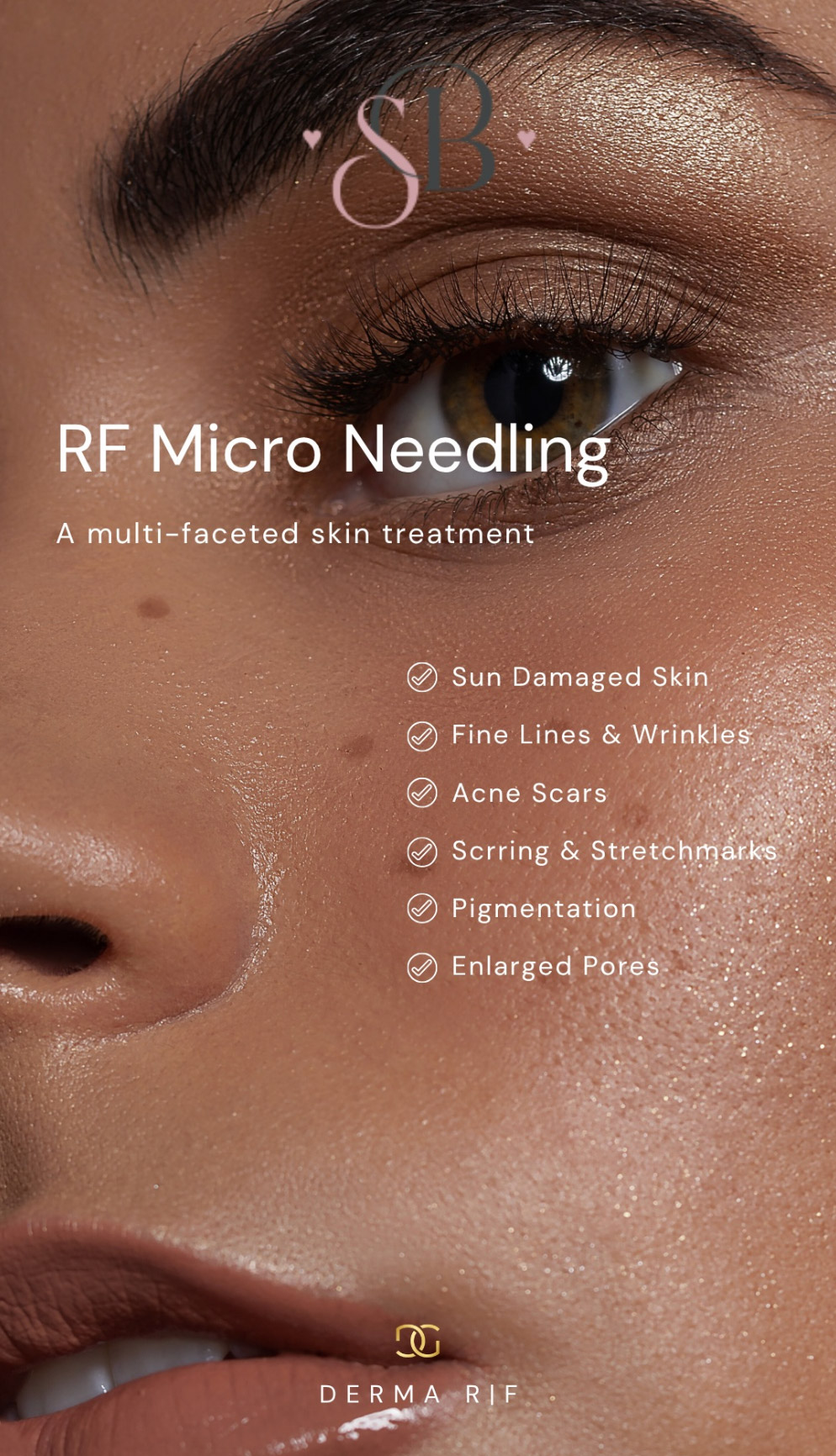 Microneedling York