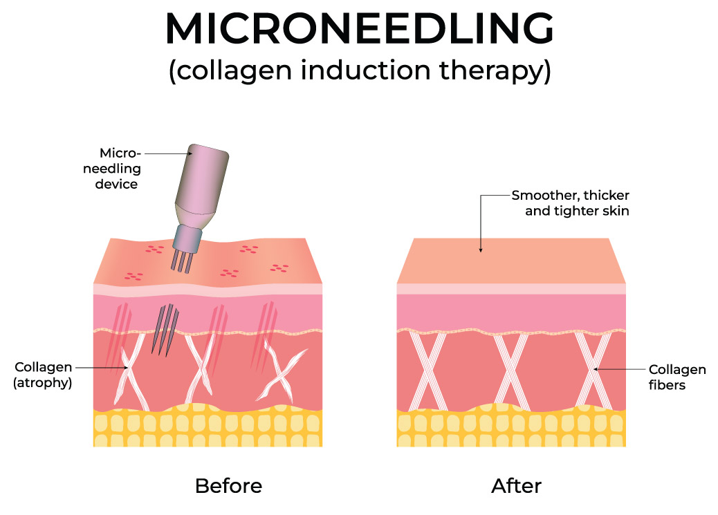 Micro Needling Collagen Induction Therapy Micro Needling Collagen Induction Therapy